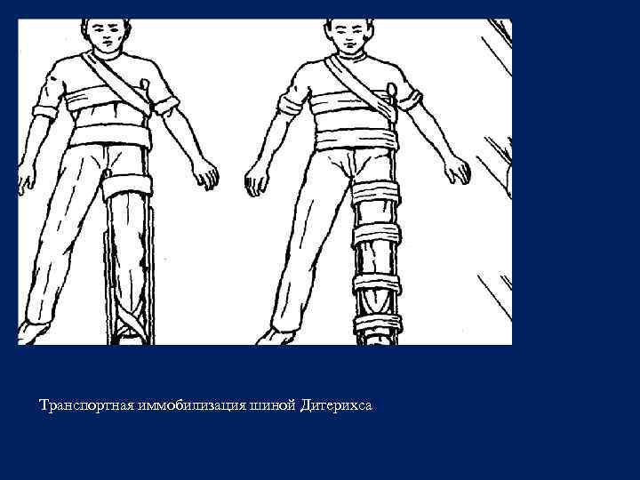 Транспортная иммобилизация шиной Дитерихса 