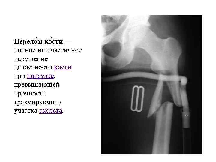 Перело м ко сти — полное или частичное нарушение целостности кости при нагрузке, превышающей