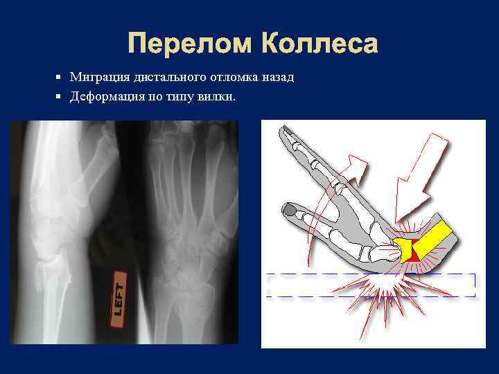 При открытом переломе тест