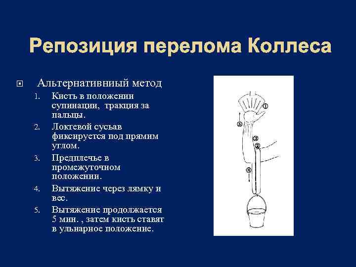 Репозиция перелома Коллеса Альтернативниый метод 1. 2. 3. 4. 5. Кисть в положении супинации,