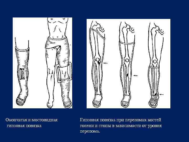 Гипсовые повязки при переломах костей
