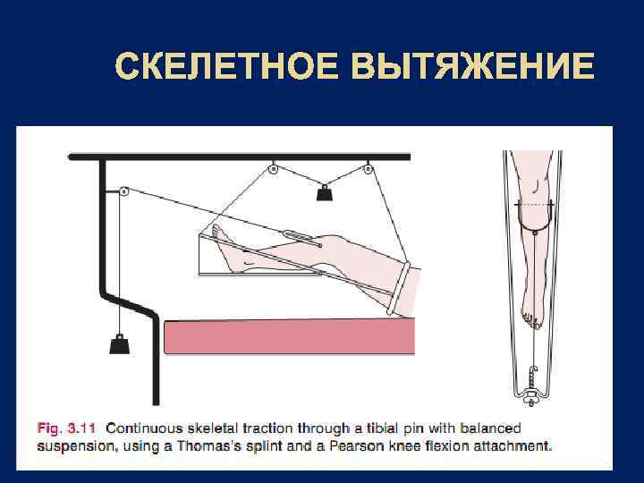 Схема скелетного вытяжения при переломах бедренной кости