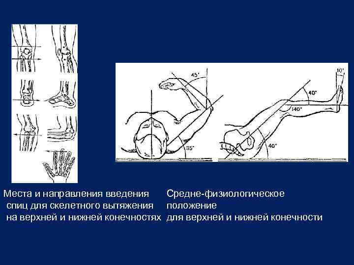 Места и направления введения Средне-физиологическое спиц для скелетного вытяжения положение на верхней и нижней