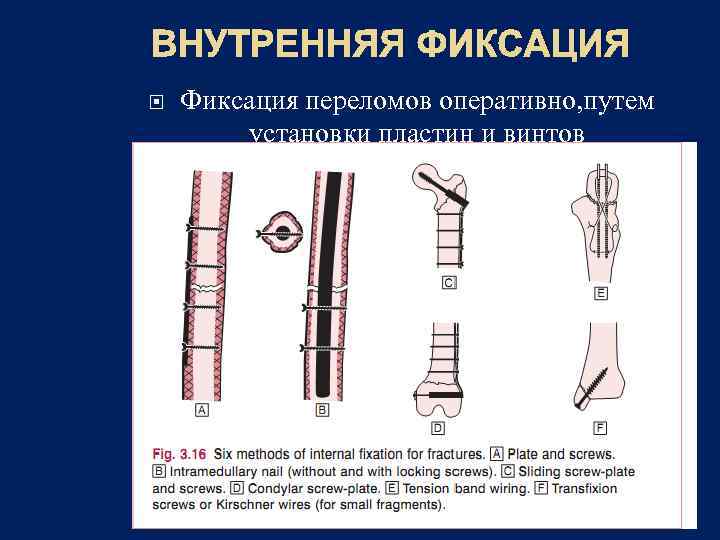 Оперативным путем. Методы фиксации переломов. Методы фиксации при переломах. Современные методы фиксации переломов. Внешняя фиксация перелома.