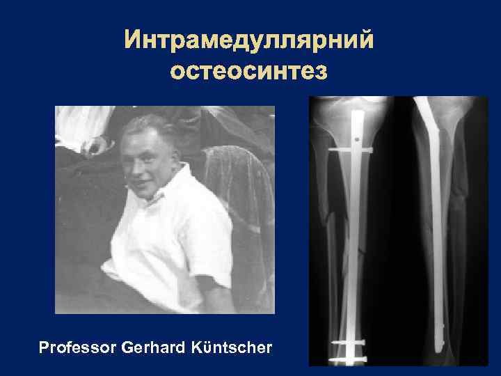 Интрамедуллярний остеосинтез Professor Gerhard Kϋntscher 