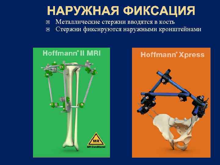 НАРУЖНАЯ ФИКСАЦИЯ Металлические стержни вводятся в кость Стержни фиксируются наружными кронштейнами 