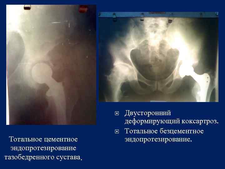 Двусторонний деформирующий