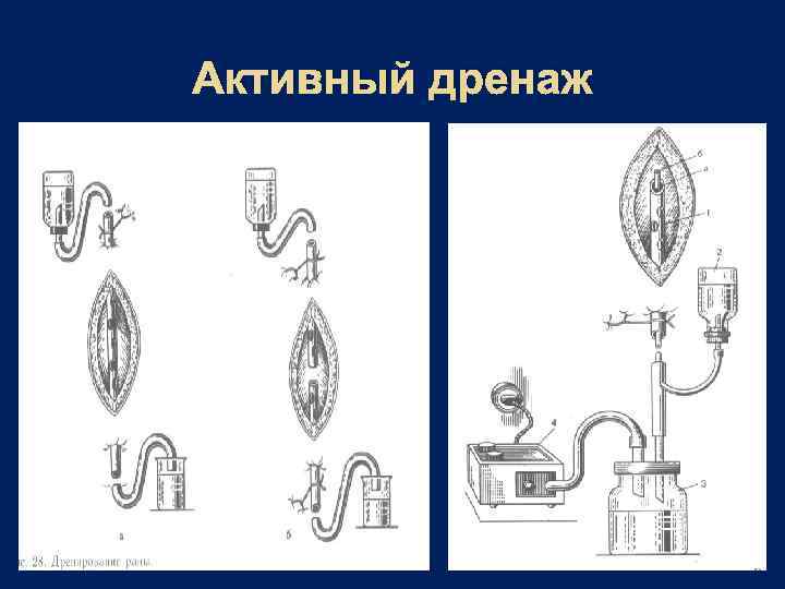 Активный дренаж 