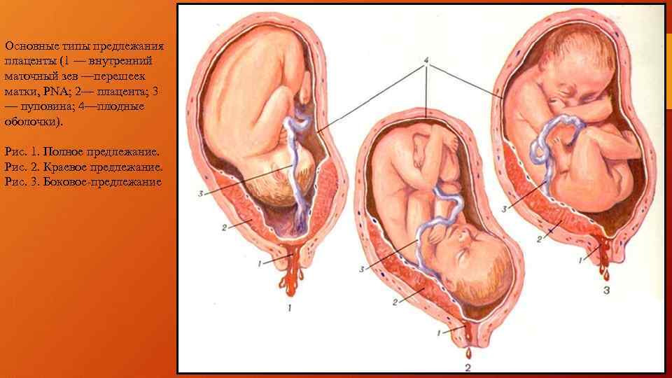 Основные типы предлежания плаценты (1 — внутренний маточный зев —перешеек матки, PNA; 2— плацента;