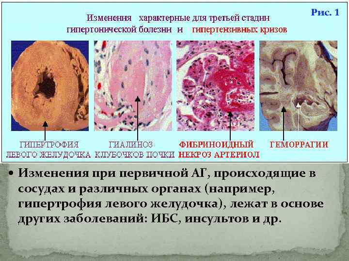  Изменения при первичной АГ, происходящие в сосудах и различных органах (например, гипертрофия левого