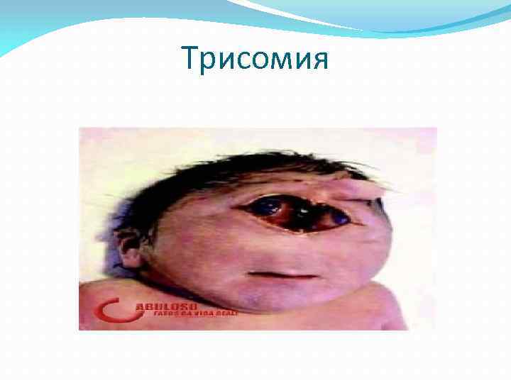 Трисомия 