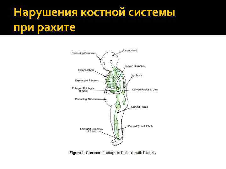 Нарушения костной системы при рахите 