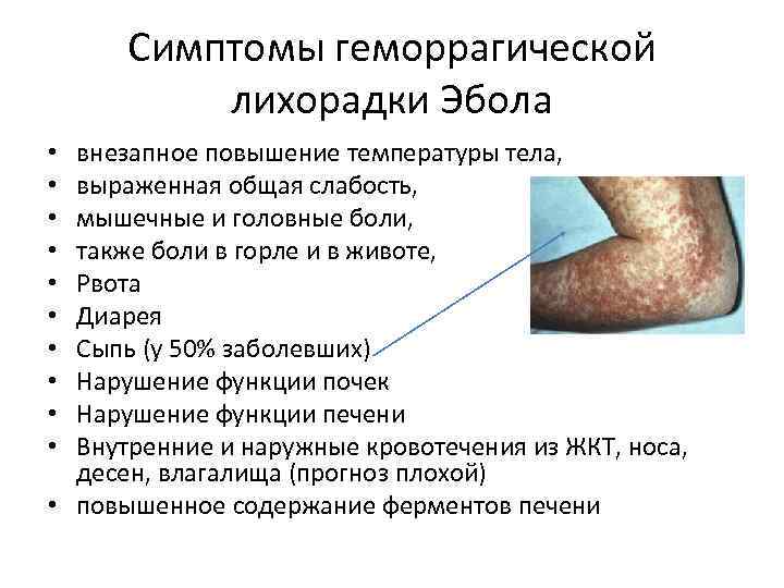 Симптомы геморрагической лихорадки Эбола внезапное повышение температуры тела, выраженная общая слабость, мышечные и головные