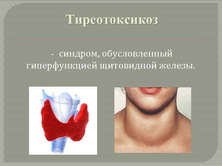 Тиреотоксикоз щитовидной железы. Синдром гиперфункции щитовидной железы. Заболевания, обусловленные гиперфункцией щитовидной железы. Профилактика гиперфункции щитовидной железы.