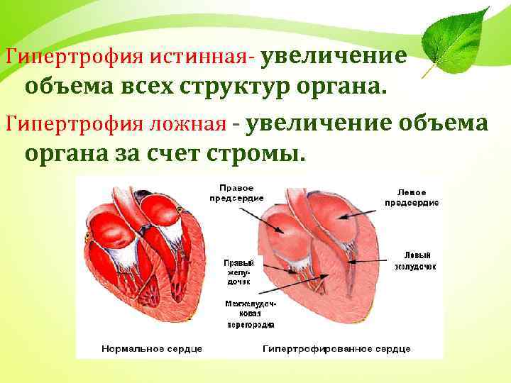 Рост органа. Ложная гипертрофия примеры.