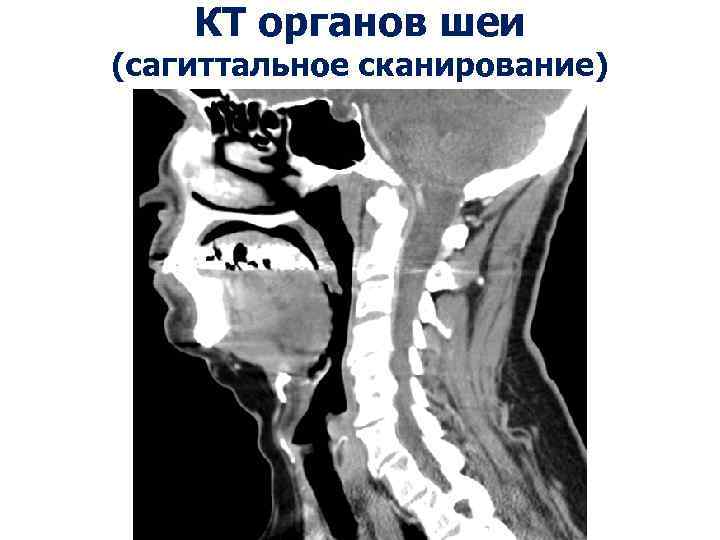 КТ органов шеи (сагиттальное сканирование) 
