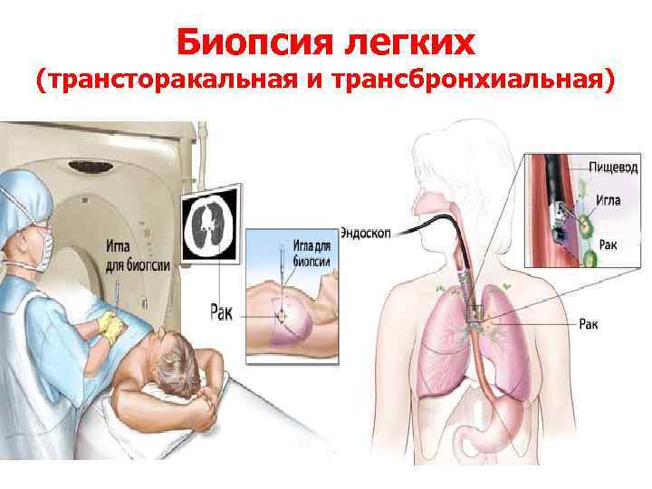 Биопсия легких (трансторакальная и трансбронхиальная) 