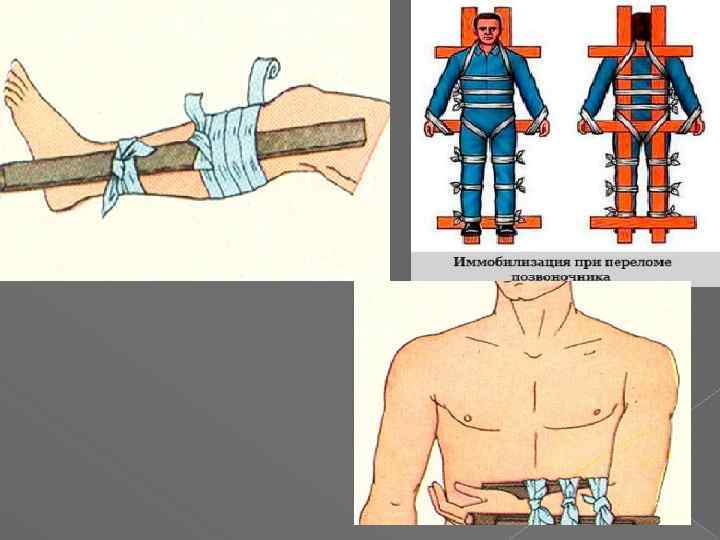 Транспортная иммобилизация картинки