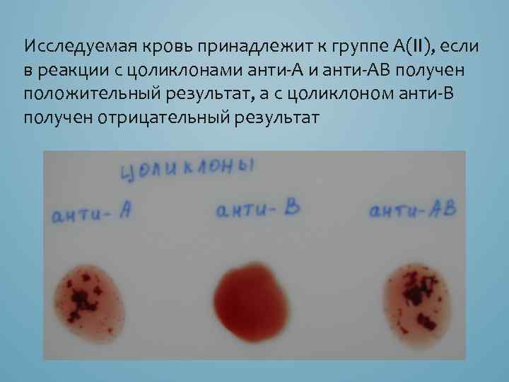 Исследуемая кровь принадлежит к группе А(II), если в реакции с цоликлонами анти АВ получен