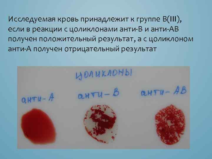 Исследуемая кровь принадлежит к группе B(III), если в реакции с цоликлонами анти В и