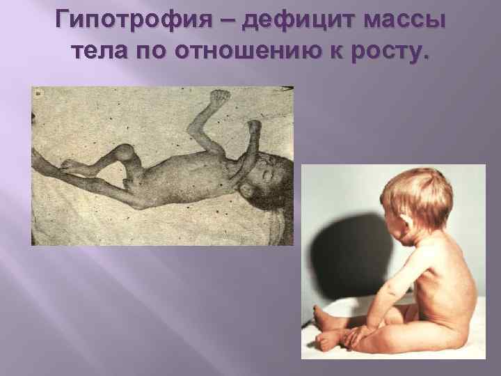 Гипотрофия – дефицит массы тела по отношению к росту. 