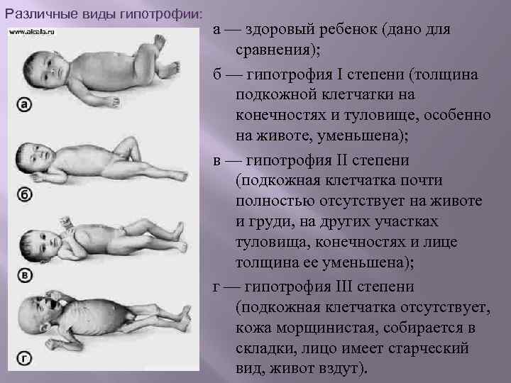 Различные виды гипотрофии: а — здоровый ребенок (дано для сравнения); б — гипотрофия I