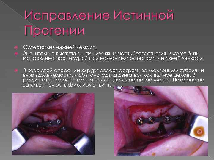 Исправление Истинной Прогении Остеотомия нижней челюсти Значительно выступающая нижняя челюсть (ретрогнатия) может быть исправлена