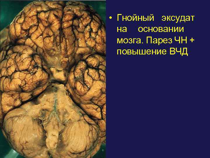  • Гнойный эксудат на основании мозга. Парез ЧН + повышение ВЧД 