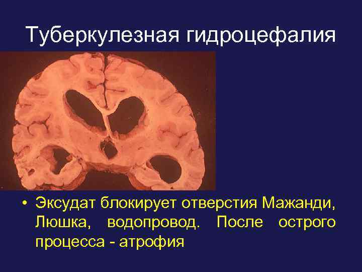 Туберкулезная гидроцефалия • Эксудат блокирует отверстия Мажанди, Люшка, водопровод. После острого процесса - атрофия