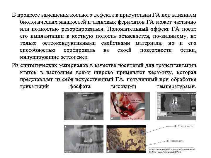 В процессе замещения костного дефекта в присутствии ГА под влиянием биологических жидкостей и тканевых