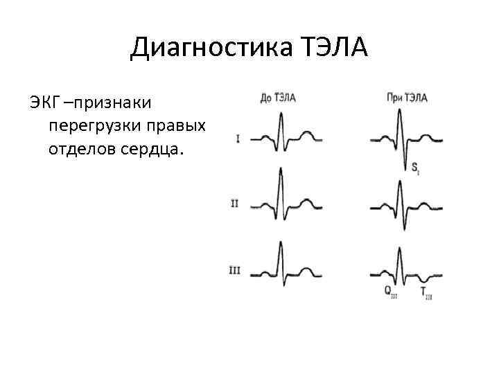 Диагностика ТЭЛА ЭКГ –признаки перегрузки правых отделов сердца. 