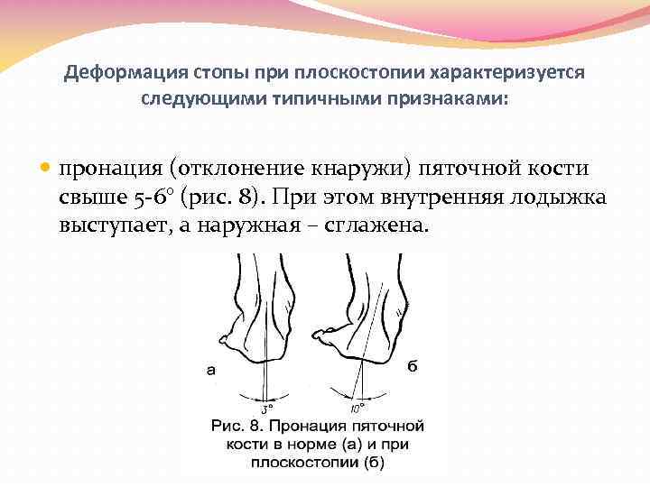 Деформация стопы при плоскостопии характеризуется следующими типичными признаками: пронация (отклонение кнаружи) пяточной кости свыше