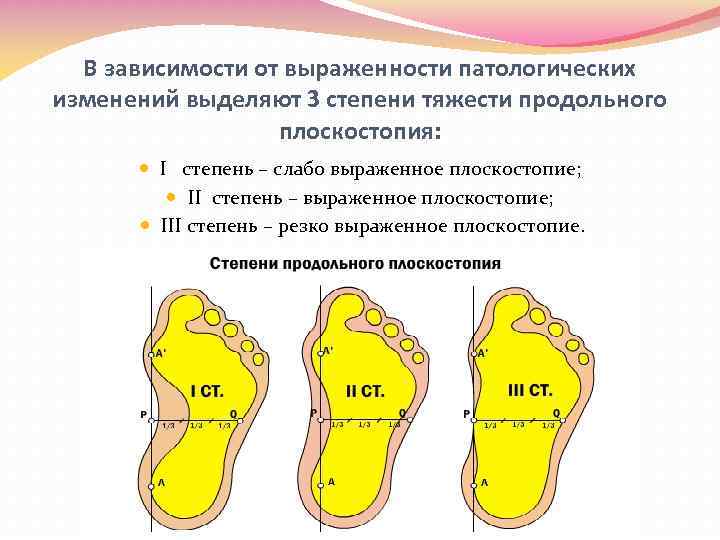 Степени продольного плоскостопия