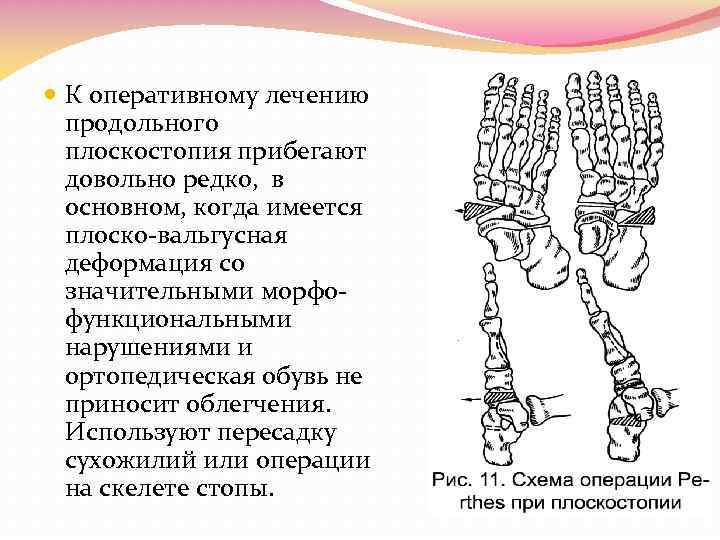  К оперативному лечению продольного плоскостопия прибегают довольно редко, в основном, когда имеется плоско-вальгусная