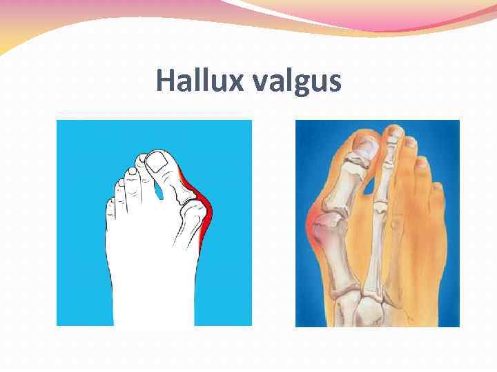 Hallux valgus 