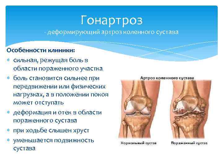 Гонартроз - деформирующий артроз коленного сустава Особенности клиники: сильная, режущая боль в области пораженного