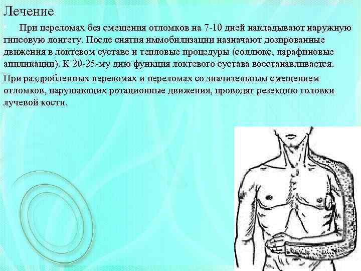 Лечение • При переломах без смещения отломков на 7 -10 дней накладывают наружную гипсовую