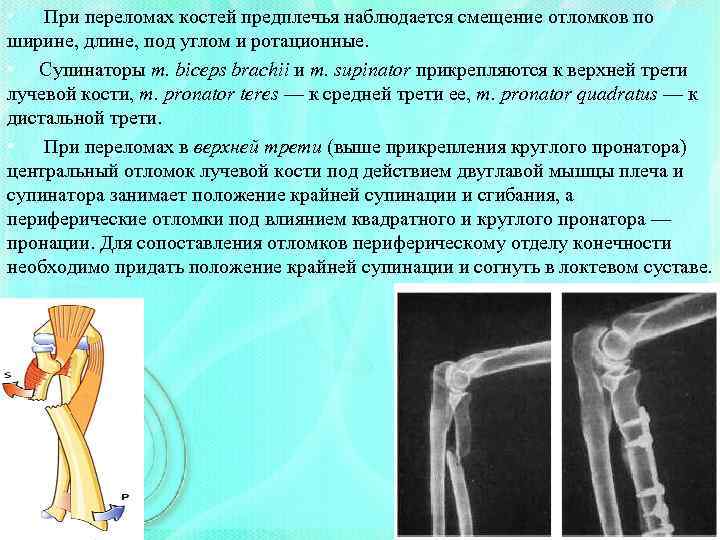  • При переломах костей предплечья наблюдается смещение отломков по ширине, длине, под углом