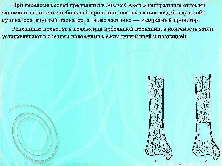  • При переломе костей предплечья в нижней трети центральные отломки занимают положение небольшой