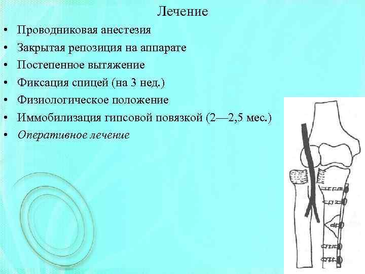 Лечение • • Проводниковая анестезия Закрытая репозиция на аппарате Постепенное вытяжение Фиксация спицей (на