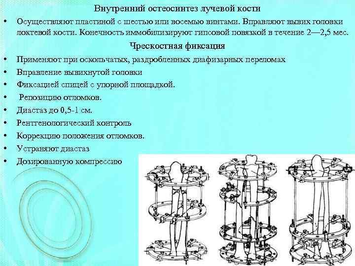 Внутренний остеосинтез лучевой кости • Осуществляют пластиной с шестью или восемью винтами. Вправляют вывих