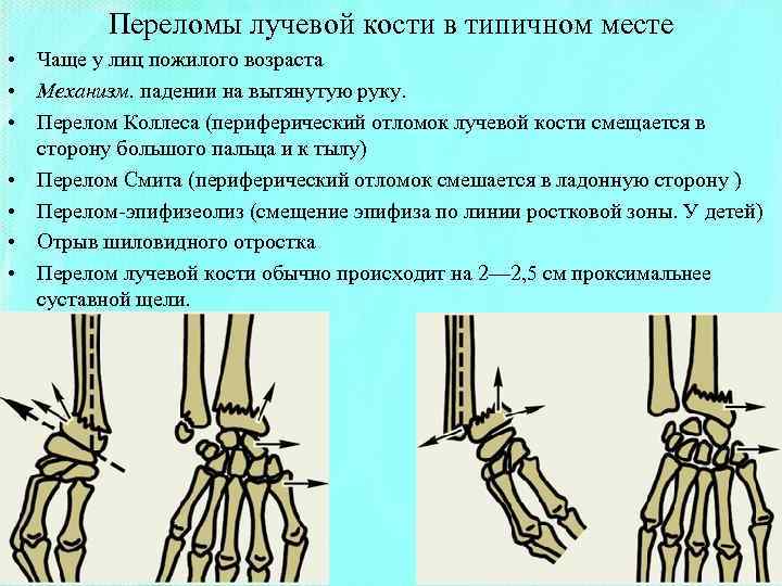 Перелом лучевой кости в типичном месте карта вызова