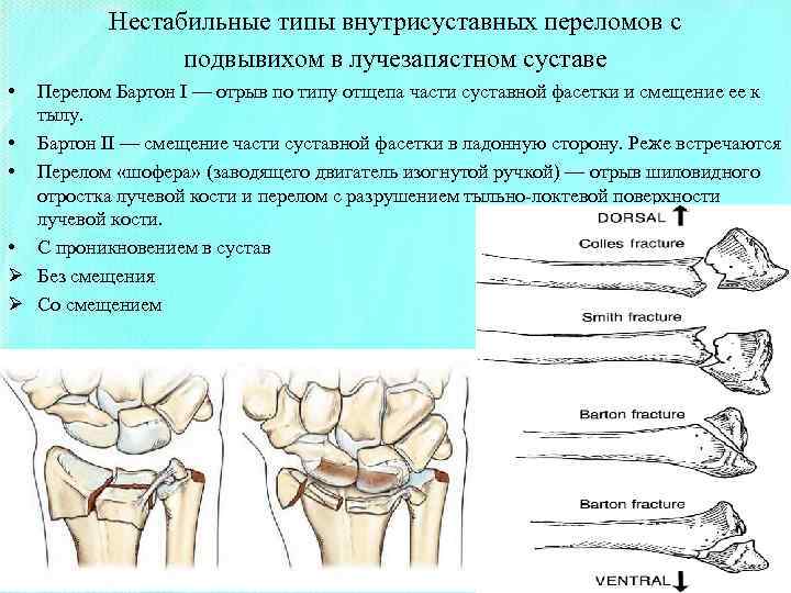 Нестабильные типы внутрисуставных переломов с подвывихом в лучезапястном суставе • Перелом Бартон I —