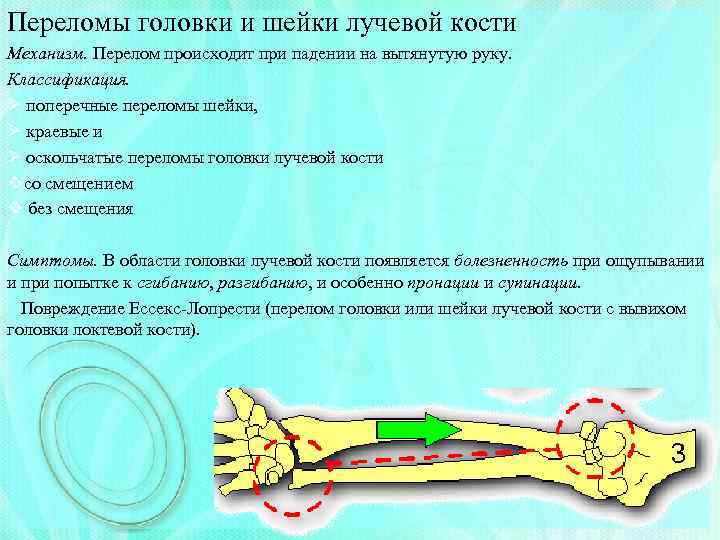 Переломы головки и шейки лучевой кости Механизм. Перелом происходит при падении на вытянутую руку.