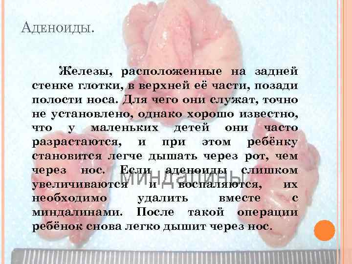 АДЕНОИДЫ. Железы, расположенные на задней стенке глотки, в верхней её части, позади полости носа.