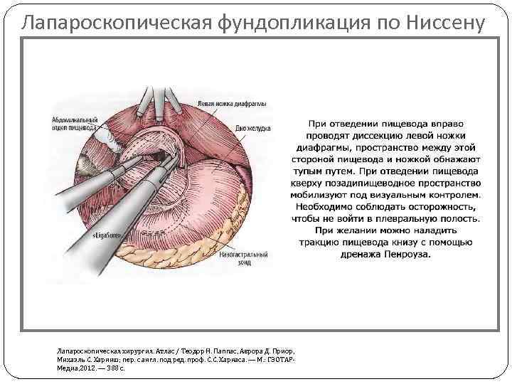 Лапароскопическая фундопликация по Ниссену Лапароскопическая хирургия. Атлас / Теодор Н. Паппас, Аврора Д. Приор,