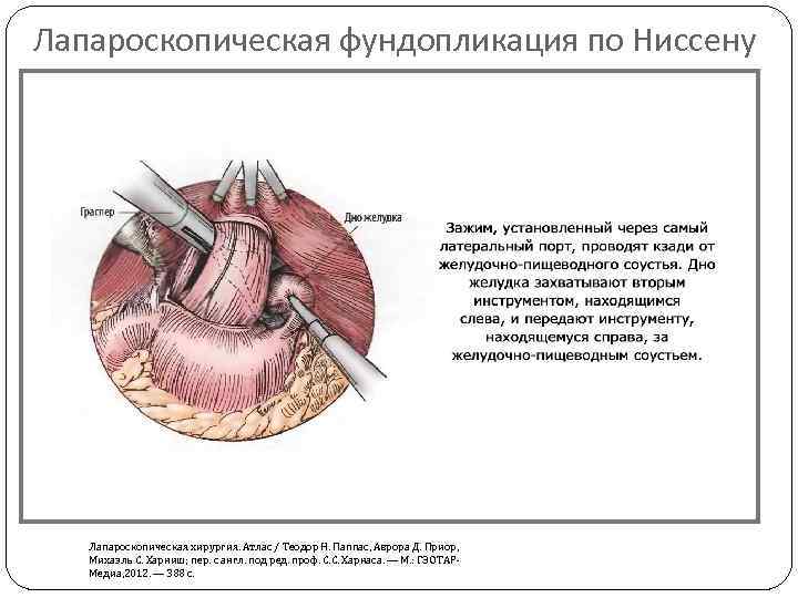 Лапароскопическая фундопликация по Ниссену Лапароскопическая хирургия. Атлас / Теодор Н. Паппас, Аврора Д. Приор,