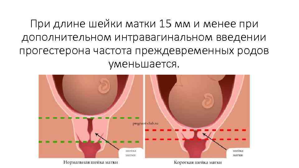 При длине шеи ки матки 15 мм и менее при дополнительном интравагинальном введении прогестерона