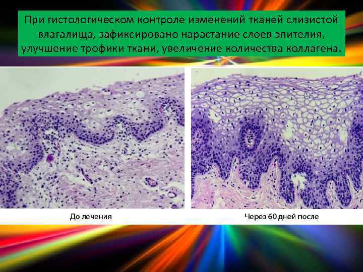 При гистологическом контроле изменений тканей слизистой влагалища, зафиксировано нарастание слоев эпителия, улучшение трофики ткани,