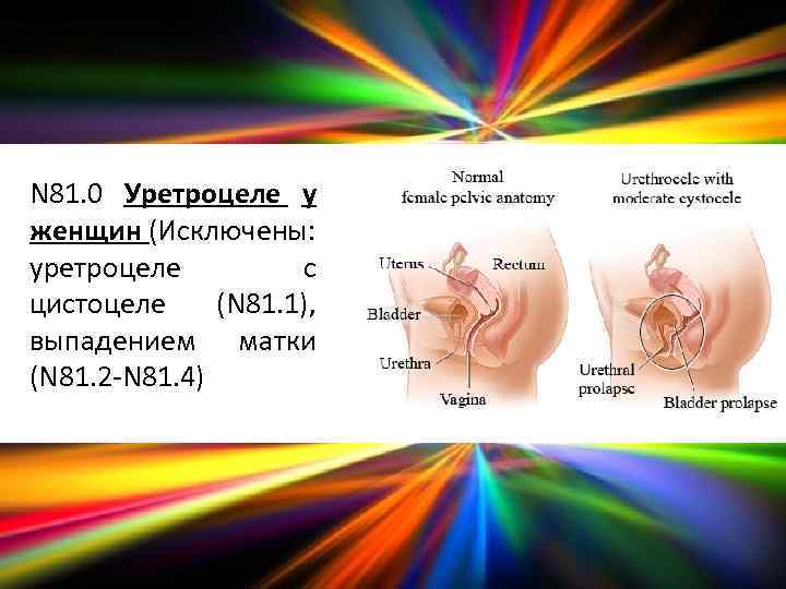 N 81. 0 Уретроцеле у женщин (Исключены: уретроцеле с цистоцеле (N 81. 1), выпадением